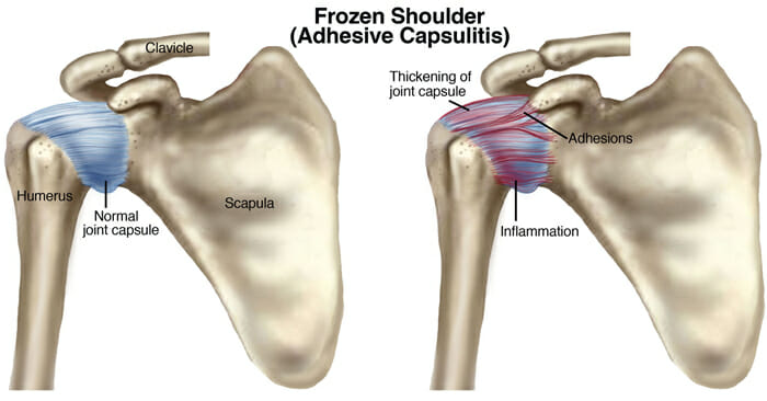 Frozen Shoulder Medical Illustration